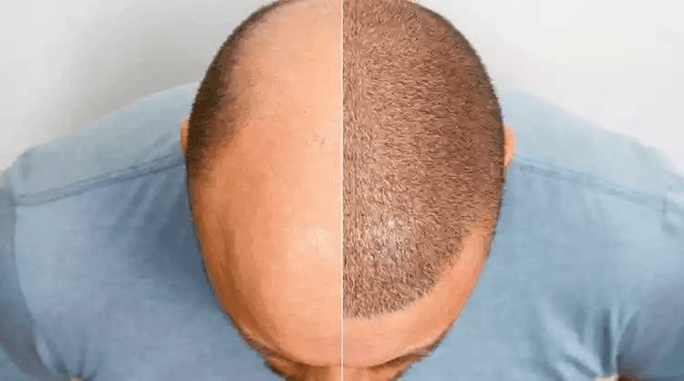 Before and after image of a person's scalp, showing hair growth treatment results.